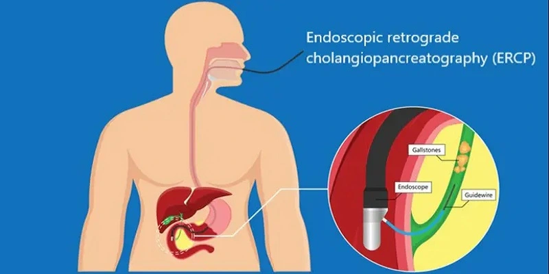 Best Doctor for ERCP in Bhandup, Mumbai